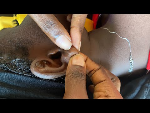 ASMR EAR PICKING, EAR HOLE PIERCING CLEANING ON A REAL PERSON WITH GUM CHEWING