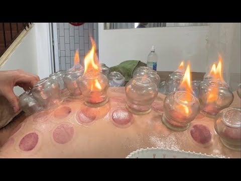 ASMR 🇻🇳 She Is a Professional Cupping Therapist | Deep Relaxation