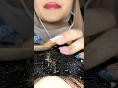 Dandruff removal 💆🏻‍♀️ #asmr #relax #visualtingle #satisfying#shorts#canada#asmrmassage#scratching