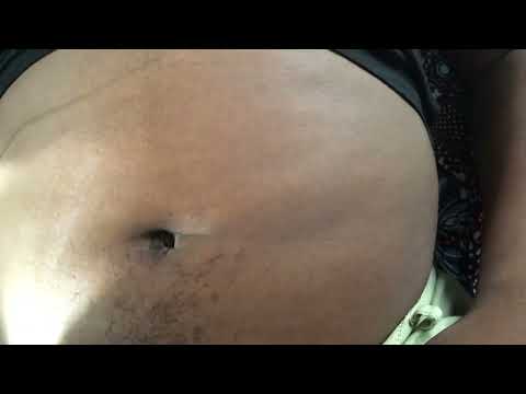 ASMR | REMOVING INGROWN HAIR ON NAVEL | Navel DEEP CLEANING
