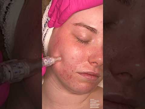 ASMR Microneedling Facial