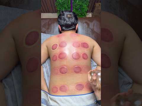 pizza peperoni cupping😍🍕#cupping #relax #asmrmassage #asmr #massage #explore #youtubeshorts