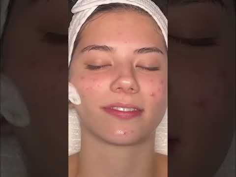Skincare Peel: Gauging Your Pain Tolerance! #shorts