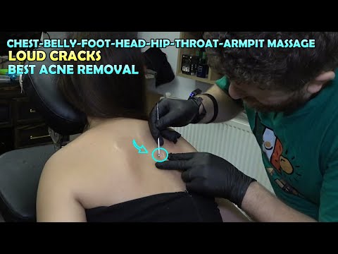SHOULDER ACNE REMOVAL FOR LADY 🌹 LOUD CRACKS + ASMR head,face,ear,chest,belly,foot,back,hip massage