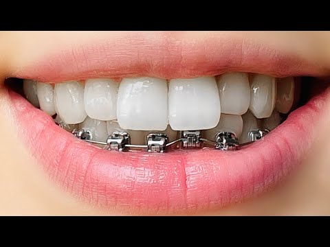 Мне поставили брекеты! АСМР🦷 / I got braces! ASMR🦷