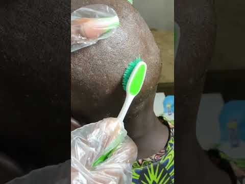 ASMR DANDRUFF SCRATCHING ON A REAL PERSON SCALP #asmr #dandruff #scalpscratching #relax