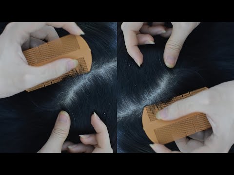 ASMR Scalp Scratching, Scalp Massage On Real Person Make You Relieve Headache, Stress