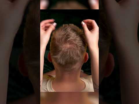 INTENSE Head Scratch ASMR (Immediate Tingles!)
