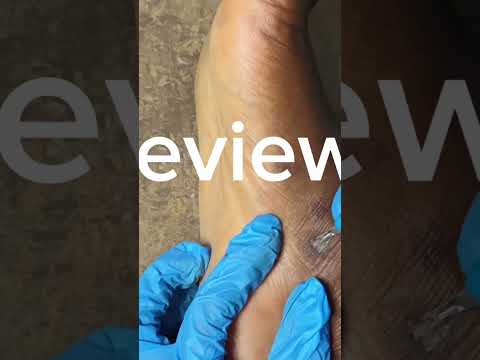 Asmr Another hug Blackheads Nitpicking and removing #asmr #blackheads #tingly