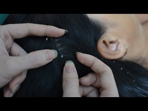 ASMR Scalp Check, Scalp Scratching, Scalp Massage Make You Feel Stress Relief ( Asmr No Talking )