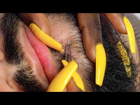 {ASMR} Face Nitpicking Whiteheads & Skin Check-Up.