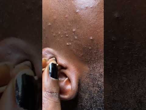 Asmr Deep ear cleaning & picking #asmr #sleepytriggers #earcleaning #earmassage