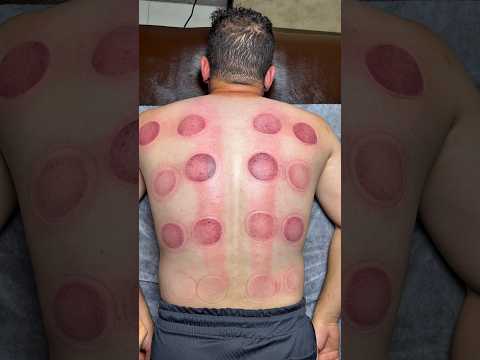 asmr cupping😍#shorts #asmr ##explore #cupping #fire