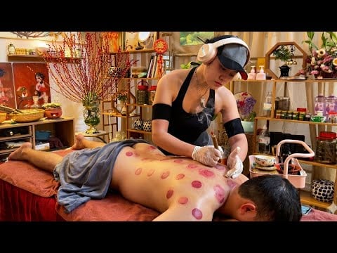 ASMR 🇻🇳 She’s a Master of Fire Cupping in Vietnam | Head Massage & Deep Relaxation