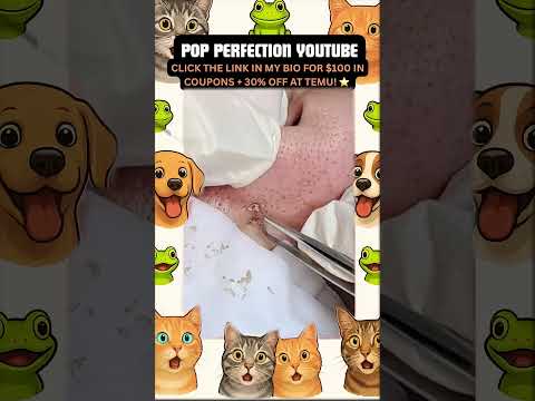 Wow! #pimpleremoval #pimple #pimples #shortsfeed #shortvideo #shorts #short #youtube #youtubeshorts