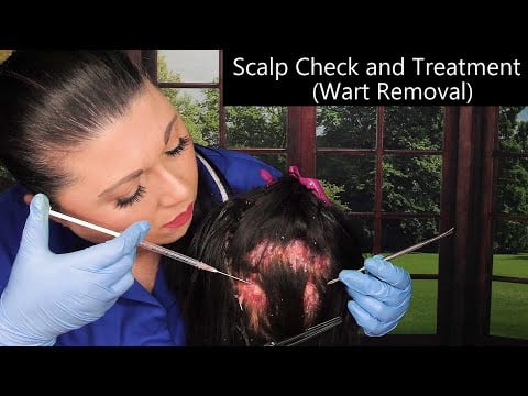 ASMR Scalp Check and Treatment (Wart Removal, Scalp Scratching, Whispering) Medical Roleplay