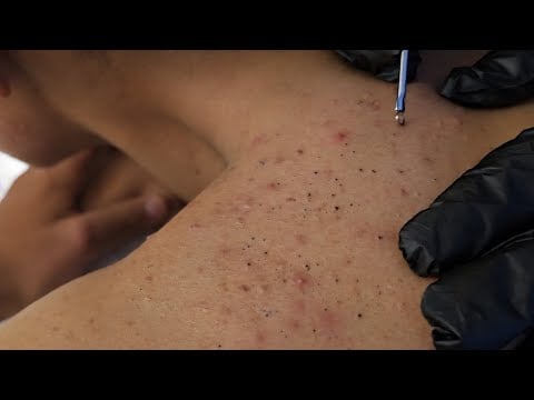 NO ADS Satisfying Blackhead & Acne Extraction 😮‍💨 Deep Pore Cleaning | Real Treatment 