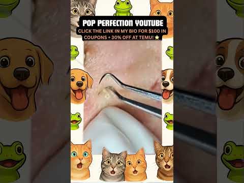 Wow! #pimpleremoval #pimple #pimples #shortsfeed #shortvideo #shorts #short #youtube #youtubeshorts