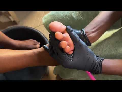 ASMR FOOT MASSAGE AND RELAXING PEDICURE, CORN REMOVAL AND NAILS CUTTING VERY RELAXING