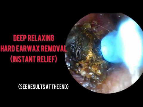 Ear Wax Removal (Very Satisfying)