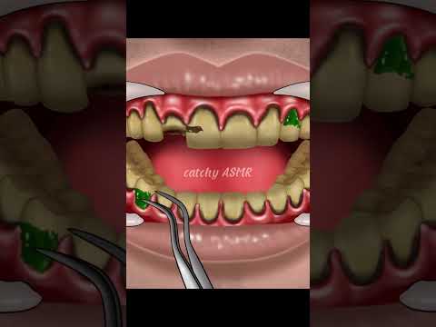 ASMR damage tooth extraction, gold teeth implant, dental decay treatment#animation #asmr #trending