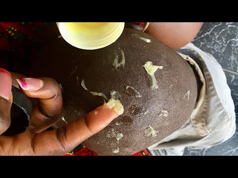 Asmr Oiling and greasing my brothers hair, after nitpicking Whiteheads And Blackheads #asmr