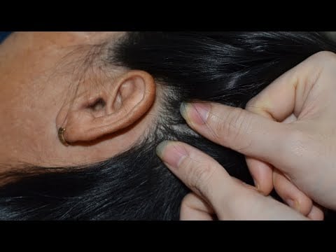 ASMR Relaxing Scalp Check, Ear Check, Scalp Scratching For Seep - Real Person Scalp Treatment