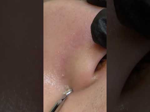 Oil Removal & Skin Care And Massage For Lady #asmr #skincare #oilremoval #acneremoval #femalemassage