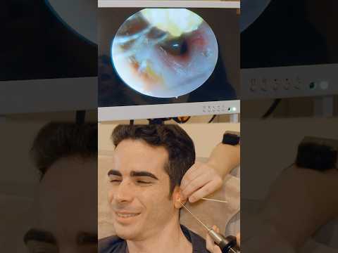 ASMR: Pulizia delle Orecchie con TELECAMERA! #shorts
