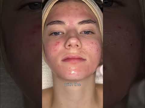 Heal Acne Scars FAST! Microneedling Treatment Explained #shorts