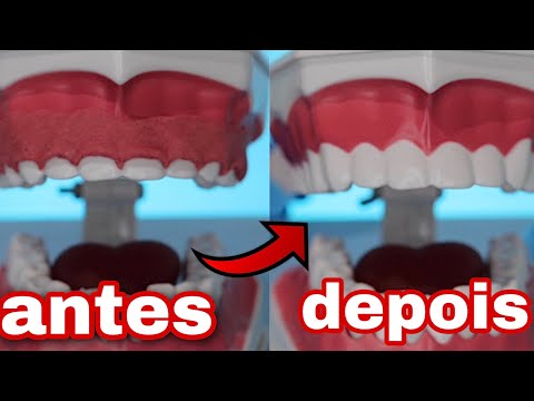 ASMR: GENGIVOPLASTIA (roleplay dentista) - cirurgia para aumentar os dentes