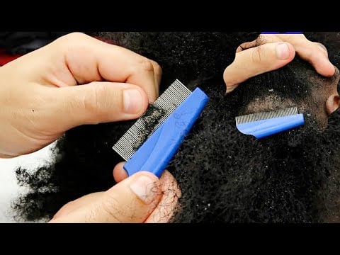 ASMR Intense Scalp Scratching flakes with a TINY COMB 🤯