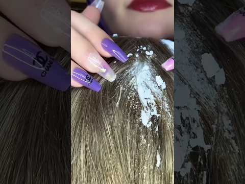 Dandruff Removal 💆🏻‍♀️ #asmr #nails #visualtingle #relax #tingles #satisfying #asmrscratching