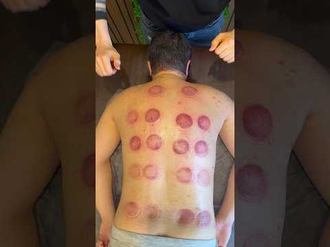cupping😍#cupping #cuppingtherapy #asmr #fire #asmrsounds #shorts #viral #trending