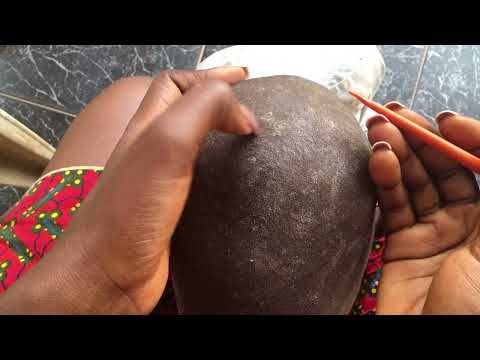 Dandruff Removal Asmr|  satisfying dandruff removal on a bald hair- intense sound 🤯 #dandruff