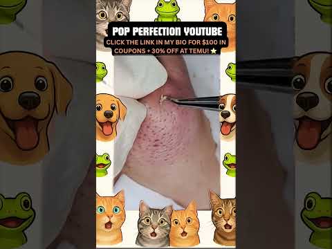 Wow! #pimpleremoval #pimple #pimples #shortsfeed #shortvideo #shorts #short #youtube #youtubeshorts