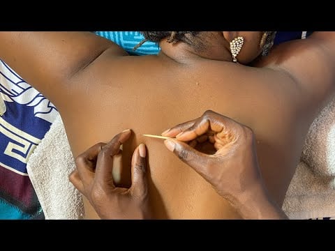 ASMR BACK SCRATCHING AND NITPICKING FOR RELAXING SLEEP WITH GUM CHEWING,BACK MASSAGE