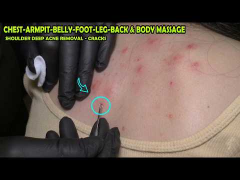 FEMALE SHOULDER ACNE REMOVAL + LOUD CRACKS + ASMR Head,Chest,Belly,Armpit,Foot,Leg & Body Massage