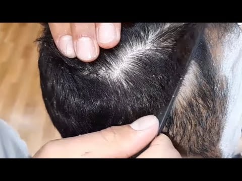 End dandruff! excellent asmr dandruff treatment and hair care asmr video