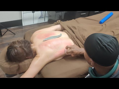 Cupping the Latissimus Dorsi and Teres Major