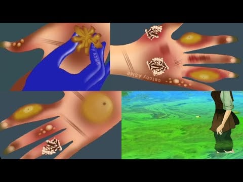 Fungal hand infection animation ASMR || Hand necrosis due to algal bloom animation ||