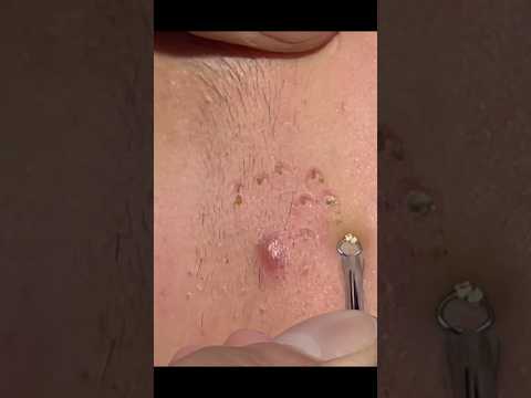 Blackhead Treatment with Clay Stone