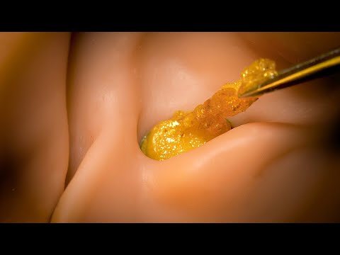 [ASMR] Ear cleaning to remove clogged earwax (Both ears / English subtitles)