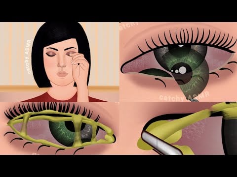 ASMR remove layer of contact lense || treatment of eye lense infection animation ASMR ||