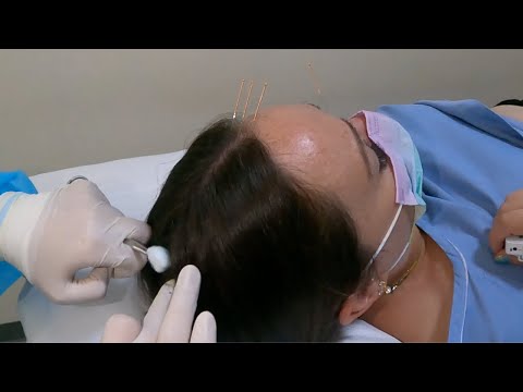 Acupuntura, Moxibustión y Baño de Pies para eliminar Insomnio y Fatiga 😴Medicina Tradicional China🇨🇳