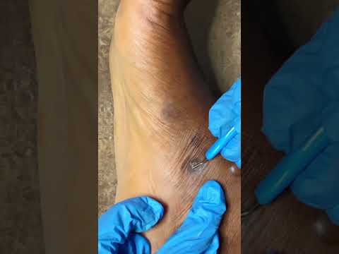 Asmr Nitpicking hug blackheads #asmr #tingling #asmrearcleaning #skincare #nitpicking