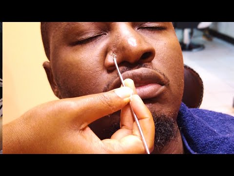 ASMR : Ultimate Blackhead Extraction and Removal
