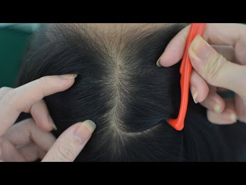ASMR Scalp Check, Scalp Scratching Aggressive Tingling For You ( No Talking )