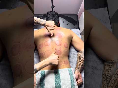 asmr cupping #cupping #shorts #cuppingtherapy #massage #asmr #relax #explore