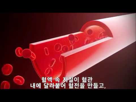 리봄한방병원 새로운 의료장비 '체외역박동치료술(EECP/ECP)'